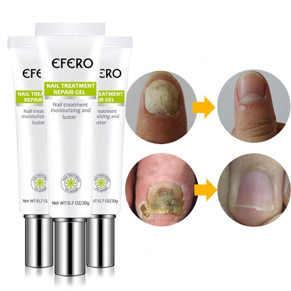 Compre 1 Leve 2 - Efero Nails® - Gel Anti Fungos e Micoses - Site Oficial De Vendas Efero Nails® - Gel Anti Fungos 001 Pandariaimports 