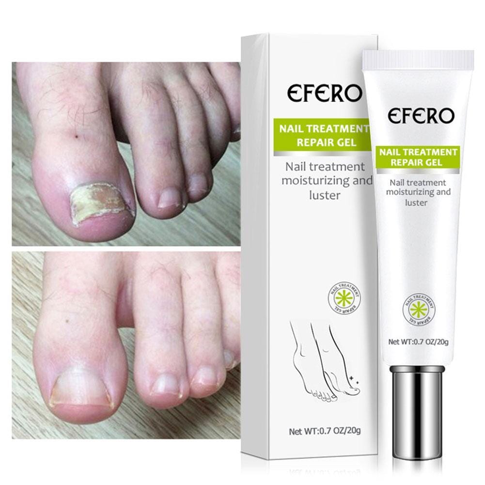 Compre 1 Leve 2 - Efero Nails® - Gel Anti Fungos e Micoses - Site Oficial De Vendas Efero Nails® - Gel Anti Fungos 001 Pandariaimports 